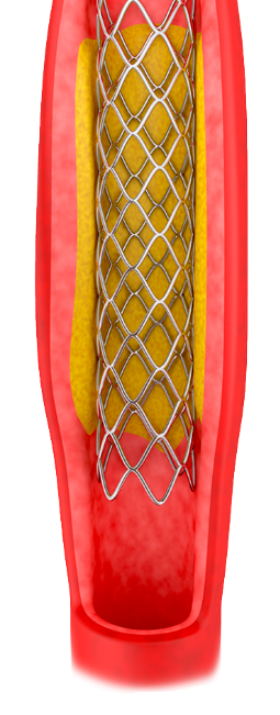 stent